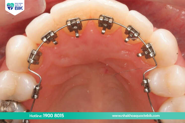 Lingual braces