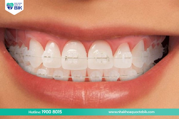 Ceramic braces