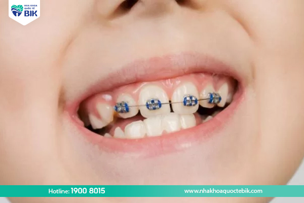 Braces for children