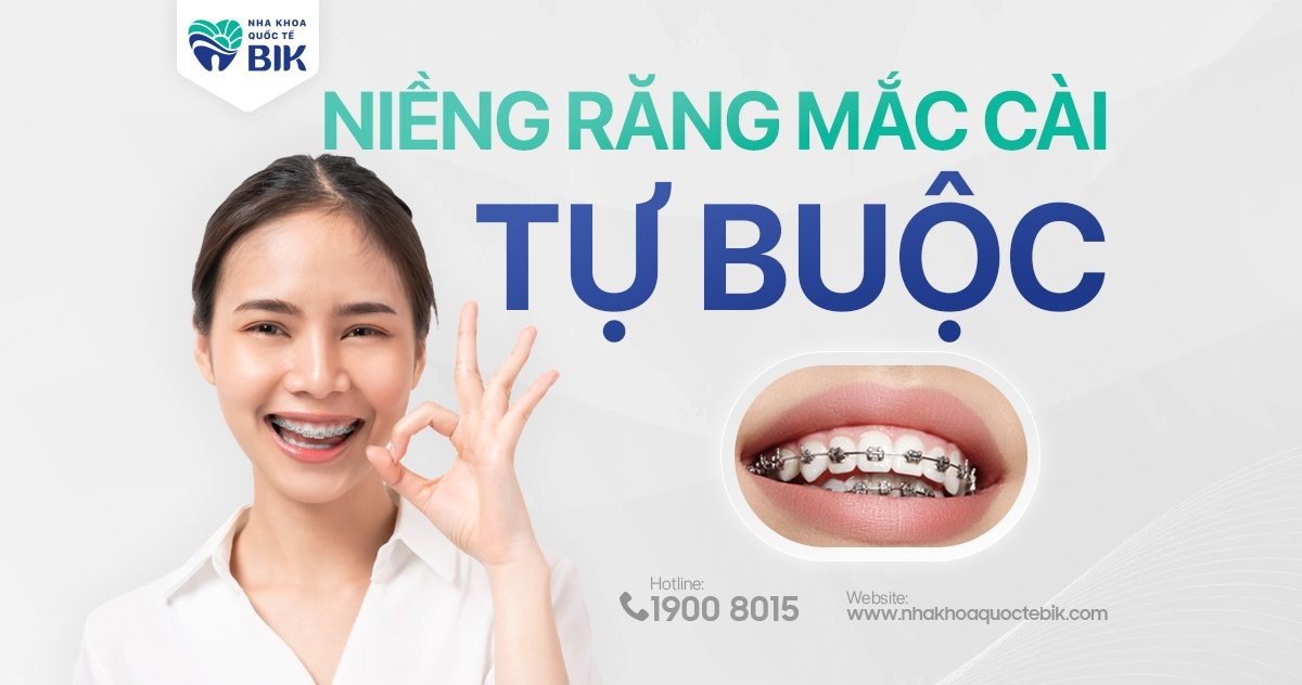 Niềng răng mắc cài tự buộc