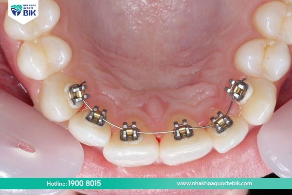 Invisalign braces