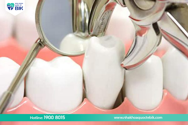 Do tooth extraction have any effect after braces?