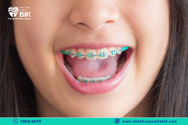 early braces to shorten the time of braces