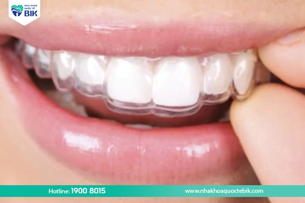 Invisalign clear braces