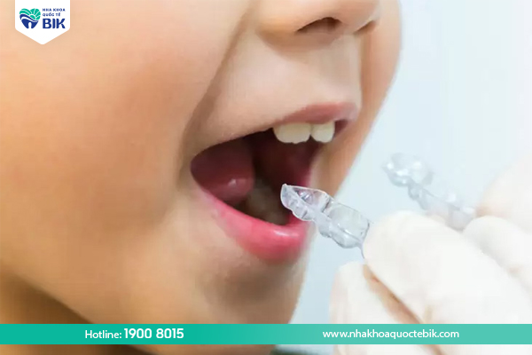 Clear braces for children