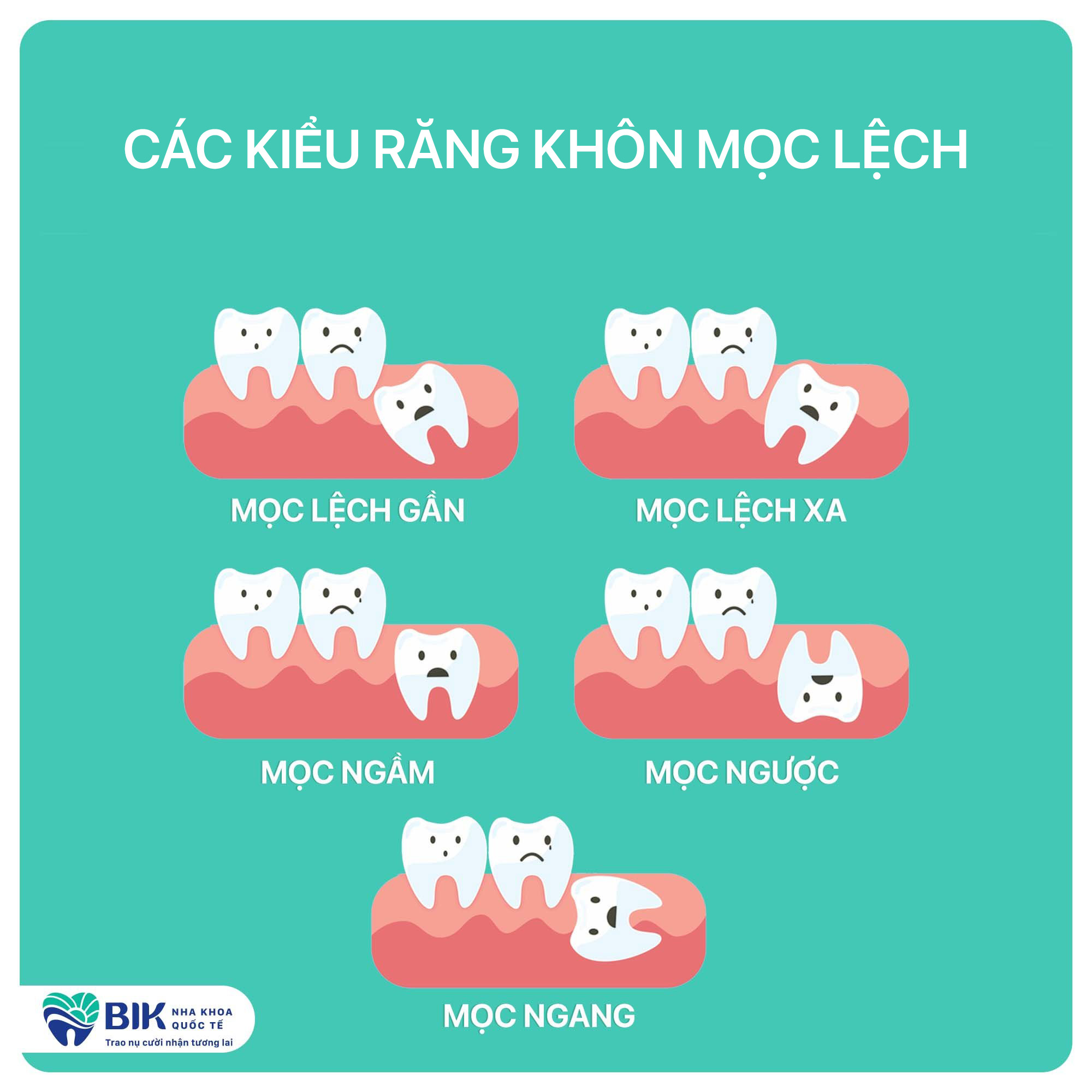 Classification of impacted wisdom teeth