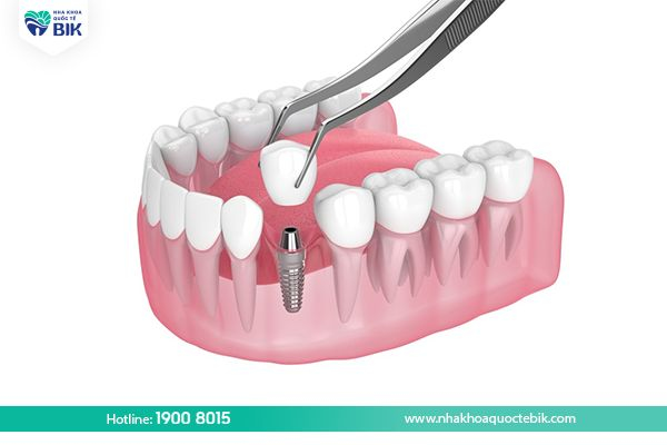 blackened tooth decay restoration