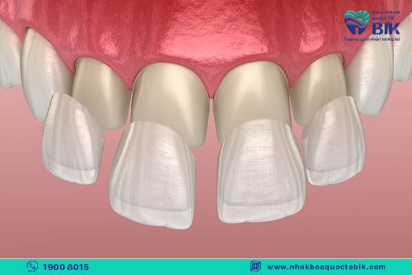 painless porcelain crown method