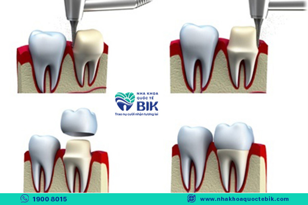 1-tooth porcelain crown process