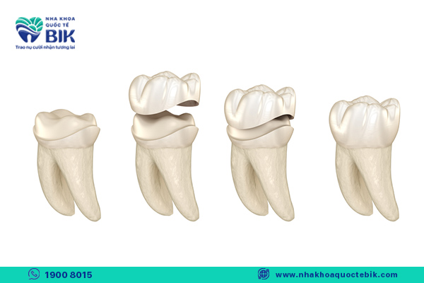 porcelain crown procedure