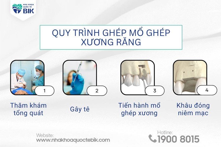 quy-trinh-ghep-mo-ghep-xuong-rang