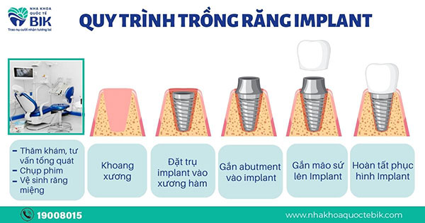 quy-trinh-trong-rang-implant