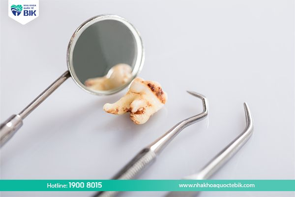 Is wisdom tooth decay dangerous?