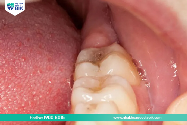 Impacted wisdom teeth cause periodontitis