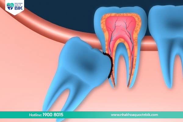 What is a wisdom tooth?