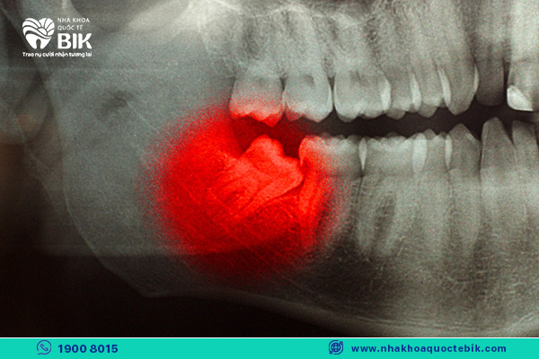 wisdom teeth growing in the wrong position need to be extracted