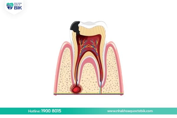 What is pulpitis?