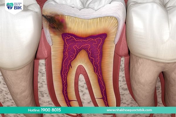 dangerous tooth decay reaching the pulp