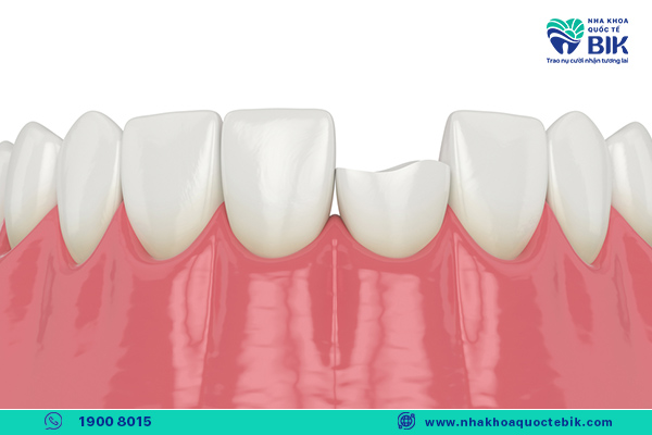 chipped porcelain teeth need to be replaced