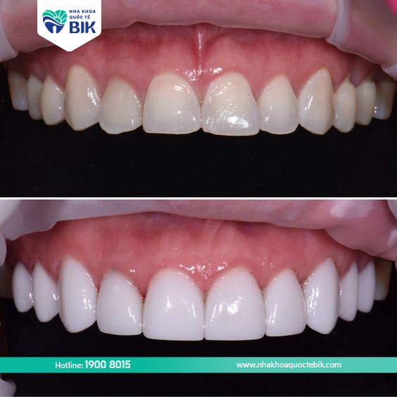 rang-su-ceramill-cua-duc