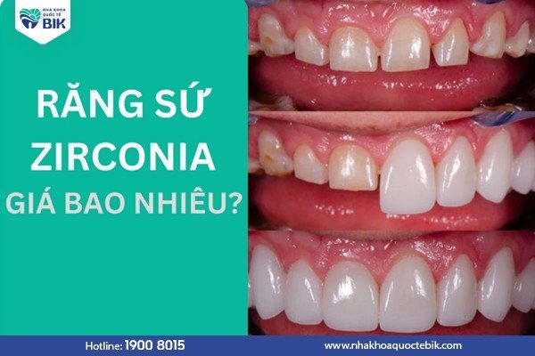 rang-su-zirconia-gia-bao-nhieu