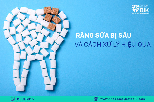 răng sữa bị sâu và cách xử lý hiệu quả