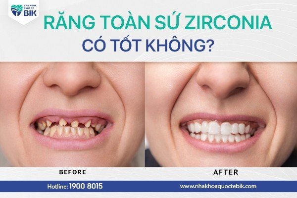 rang-toan-su-zirconia-co-tot-khong