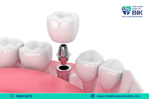 Weak teeth should not be covered with porcelain crowns