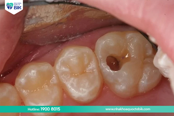 Risk of tooth decay after wisdom tooth extraction