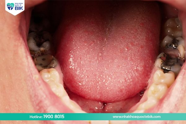 Tooth decay causes swelling of the lower jaw gums