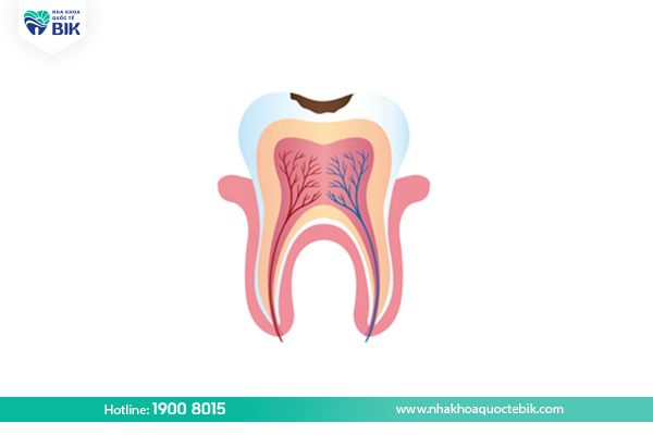 Demineralization stage of tooth decay