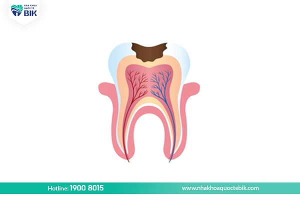 Tooth decay in the enamel decay stage