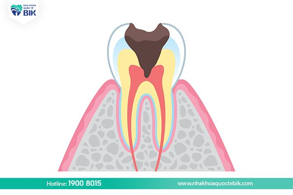 Tooth decay causes damage to the pulp