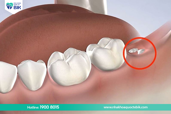 Causing a decayed tooth to fall out on its own can cause the tooth root to be left behind