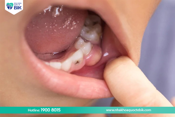 What is swollen tooth root?