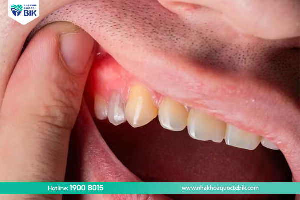 Infection after wisdom tooth extraction causes swollen gums