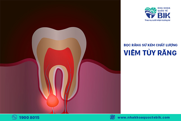 poor quality porcelain crowns cause pulpitis