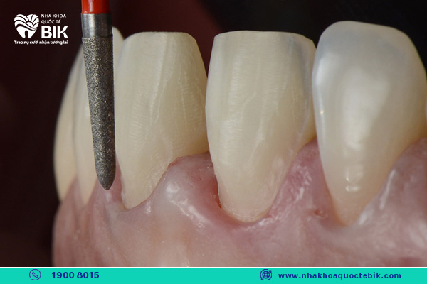 The skill of grinding the tooth stump determines whether the porcelain teeth are permanent or not