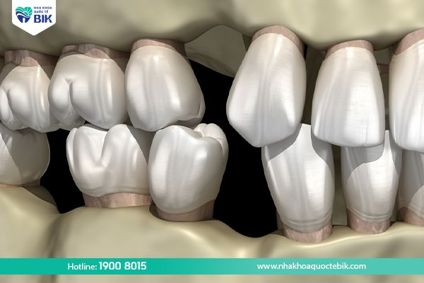 Bone loss causes tooth loss