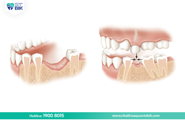 What is bone loss?