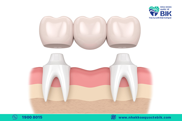 trong-rang-implant-va-cau-rang-su