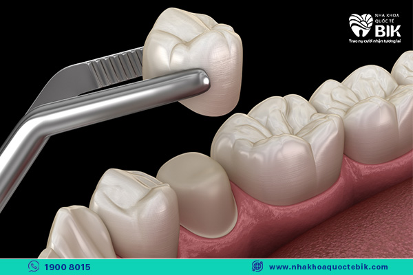 learn about porcelain crowns