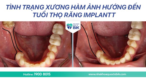 tuoi-tho-rang-implant