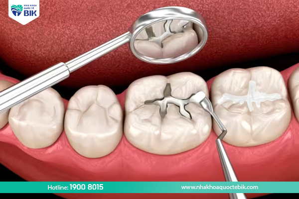 Treatment of adult tooth decay by filling