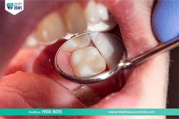 Tránh Amalgam để trám răng ở bà bầu