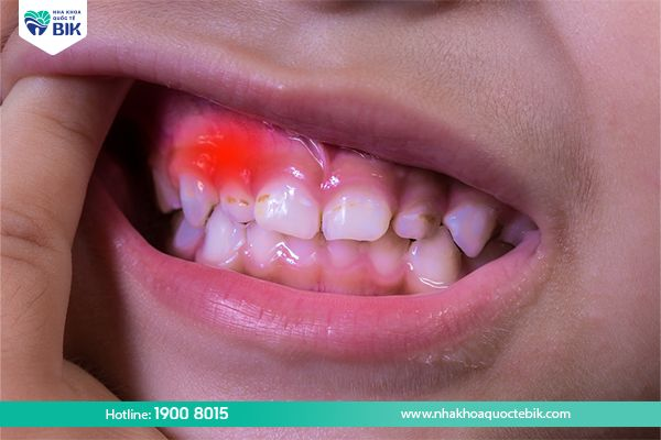 Children have swollen gums