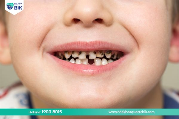 Children have swollen gums due to tooth decay