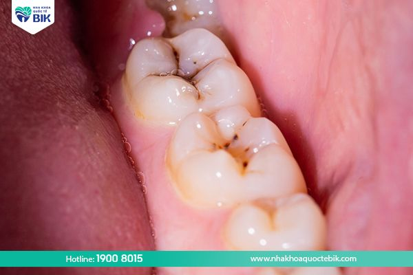 Symptoms of decayed molars