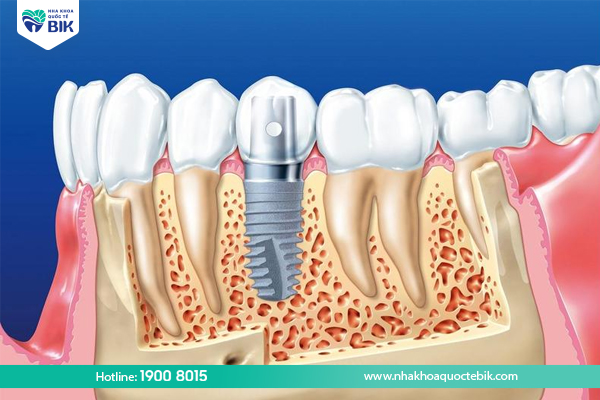 Implant dentistry to overcome jaw bone loss