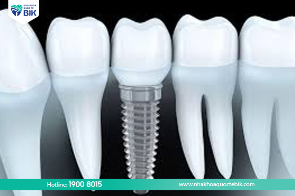 Trồng răng implant